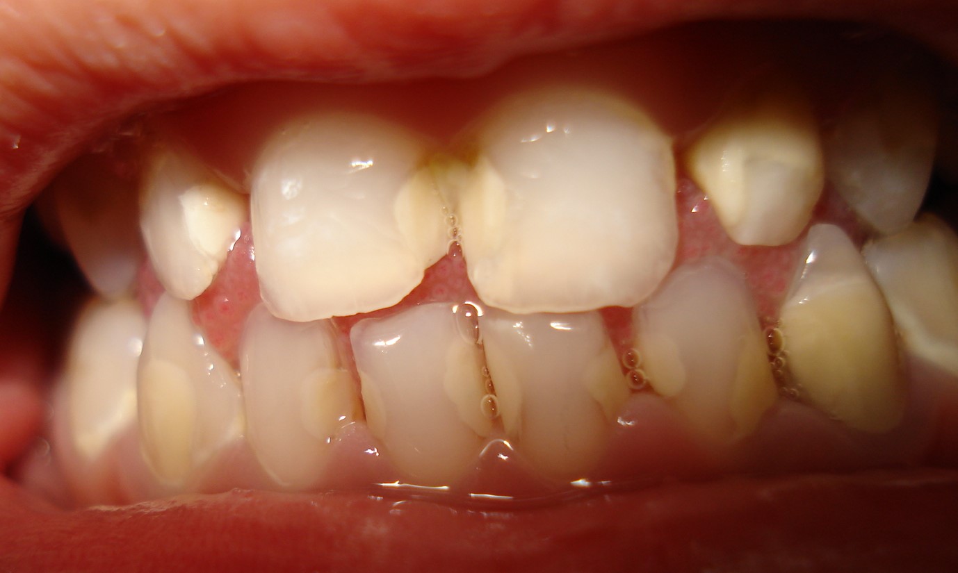 After filling rampant caries