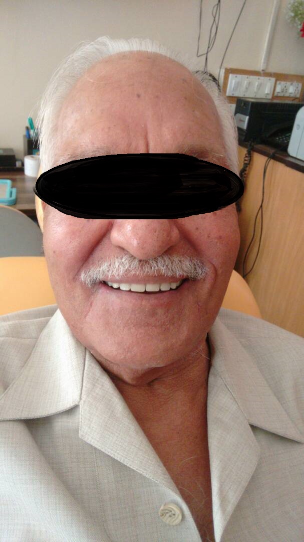 after complete denture