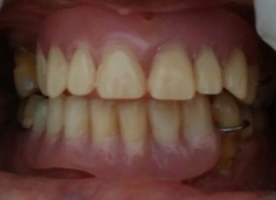 after partial denture b