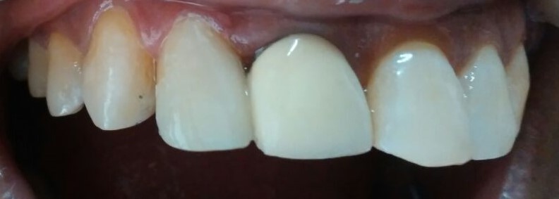 after space closure tooth coloured filling ss