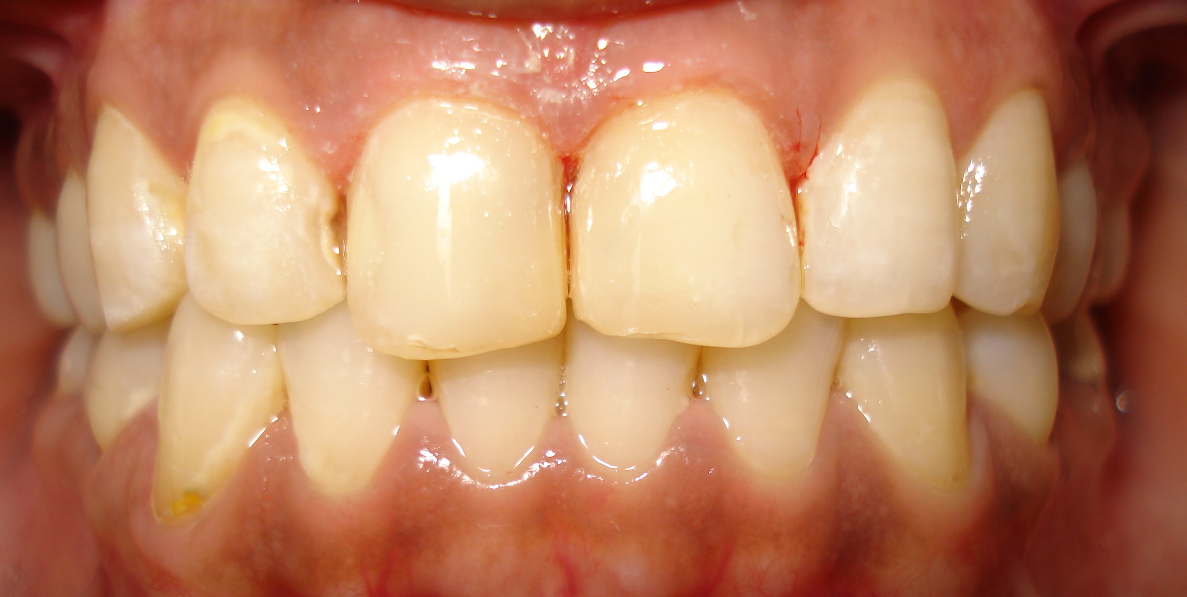 after tooth coloured filling ls