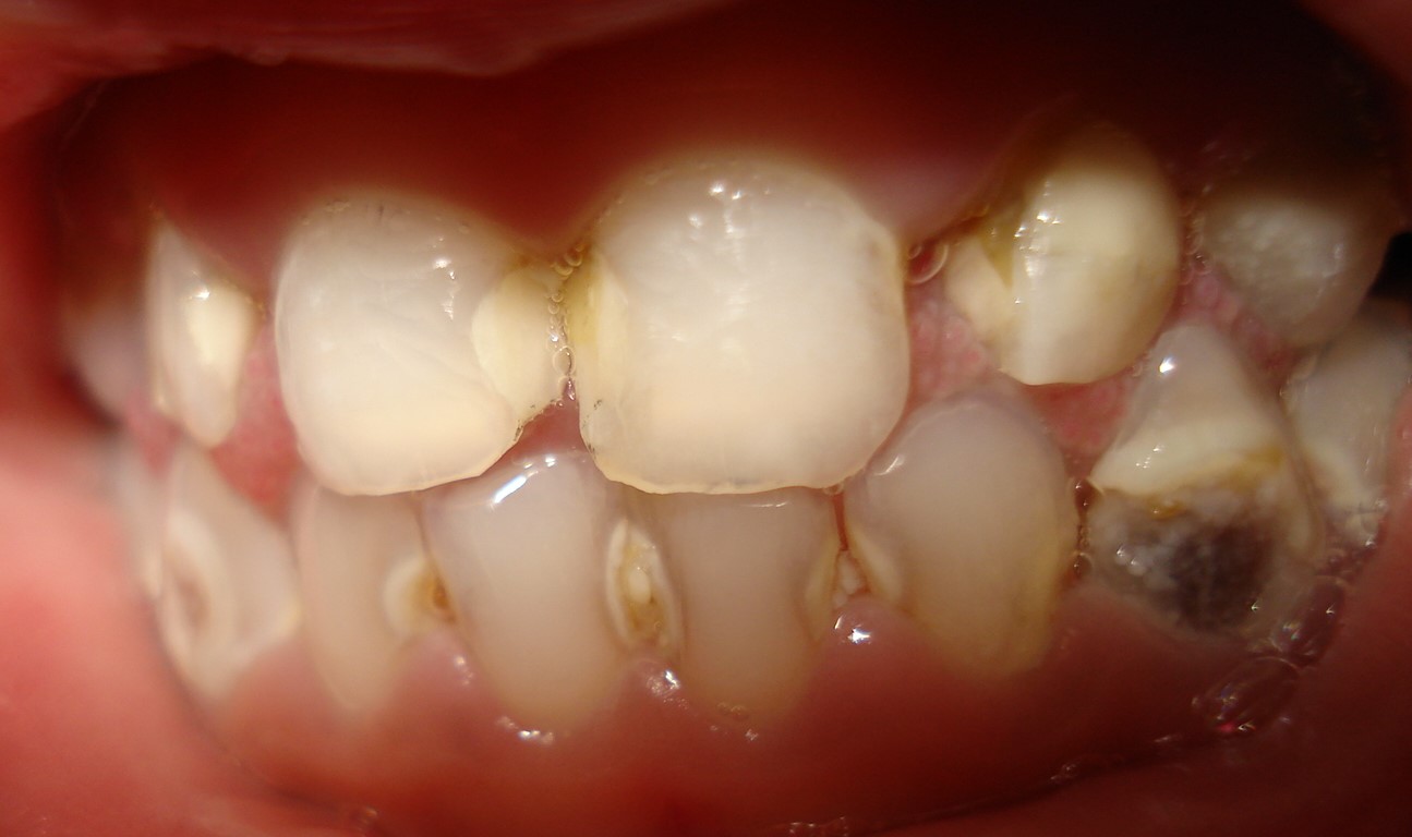 before filling rampant caries