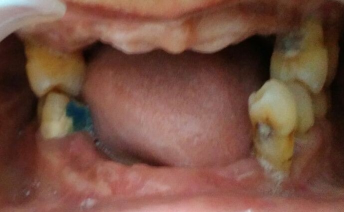 before partial denture b