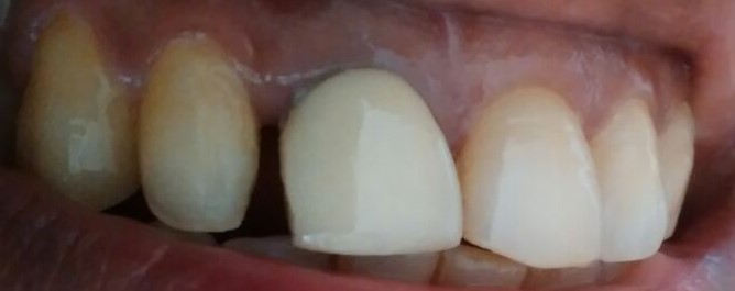 before space closure tooth coloured filling ss