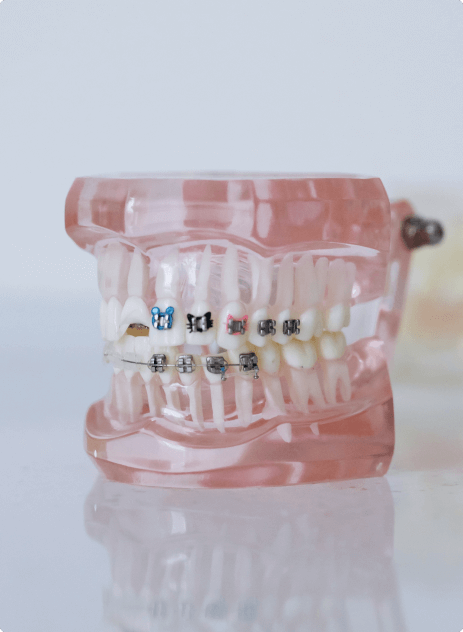 braces_side_image