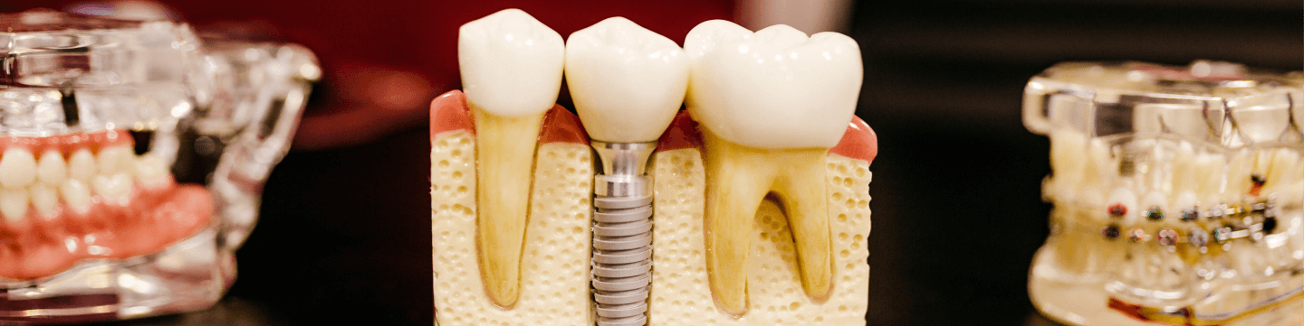 dental_implant_bg