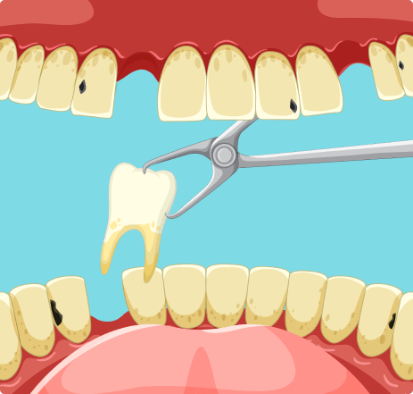 tooth_extaction_side